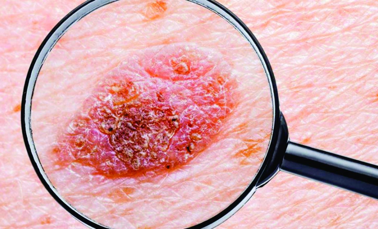 MELANOMA: O QUE ESTAMOS ERRANDO AO FALAR DE SOL, PELE E CÂNCER?